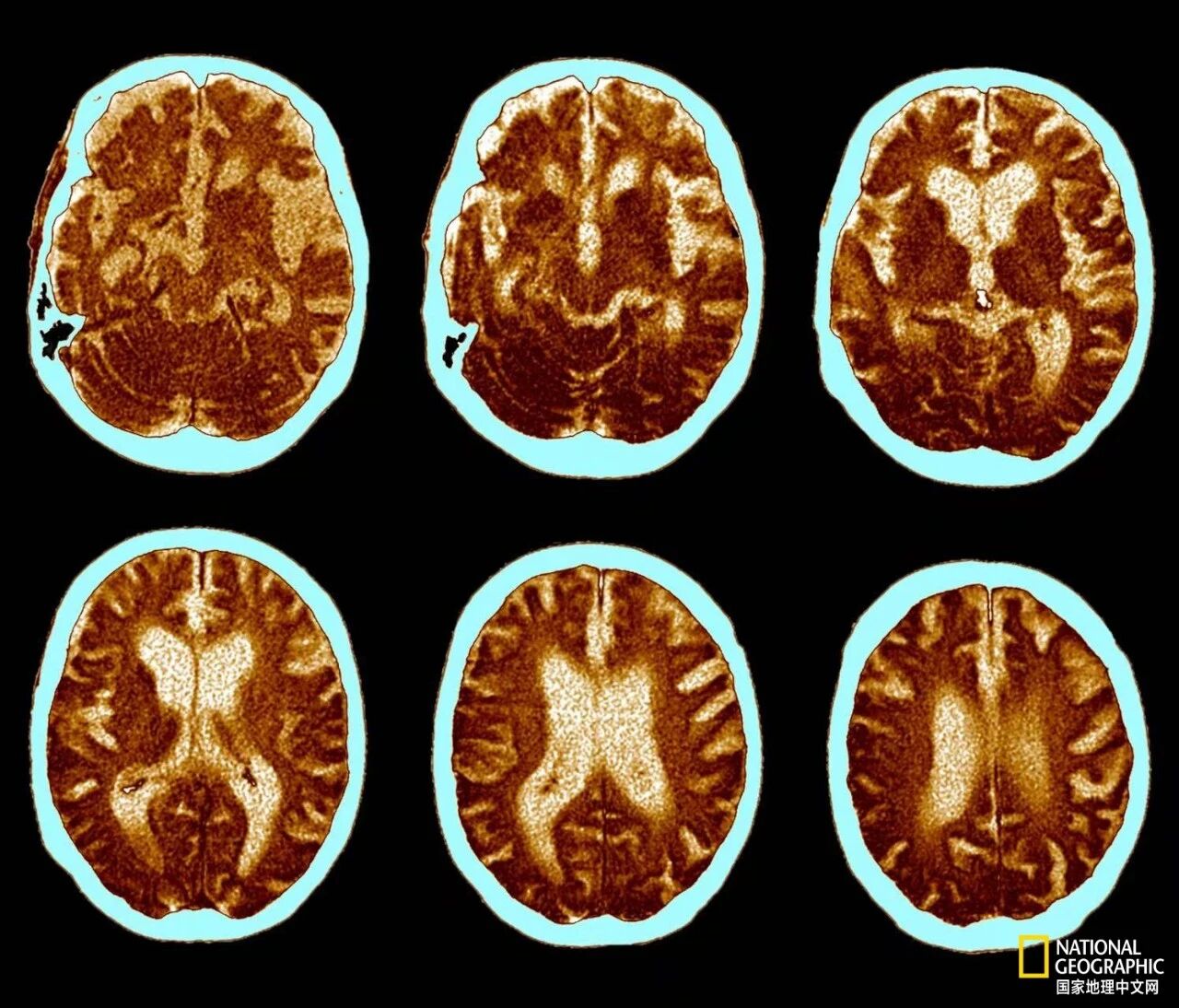 Ϊʲô�ð����ĺ�Ĭ�����ˣ����ٵð�֢����ѧ�ҷ��־��˹���