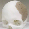 美国首创3D打印头骨技术 一病人已换75%头骨