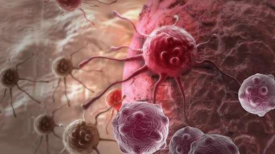 最新科学研究揭秘：为何乳腺癌常扩散至肺部？